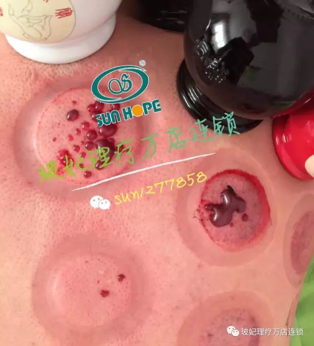 Cupping Therapy on the Back: More Effective than Medication!