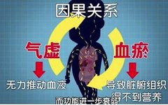 Understanding Blood Stasis Syndrome in Traditional Chinese Medicine