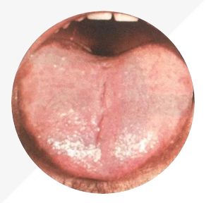 Understanding Tongue Diagnosis in TCM: Insights into Health from Tongue Appearance (Part 2)