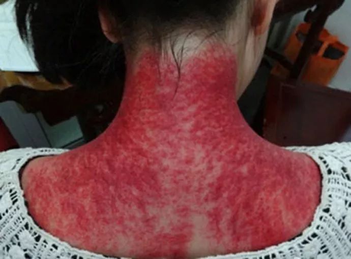 Gua Sha for All Ailments: The Importance of Correct Technique!