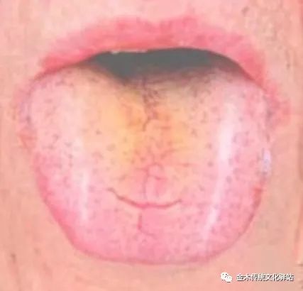 Tongue Diagnosis in Traditional Chinese Medicine: Tongue Coating