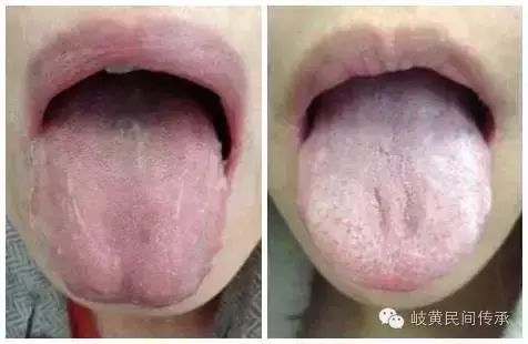 Understanding Your Body Constitution Through Tongue Coating Observation