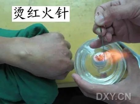 Acupuncture Department II: What Conditions Can Fire Needle Therapy Treat?