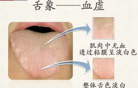 Comprehensive Guide to Tongue Diagnosis (Tongue Manifestations)