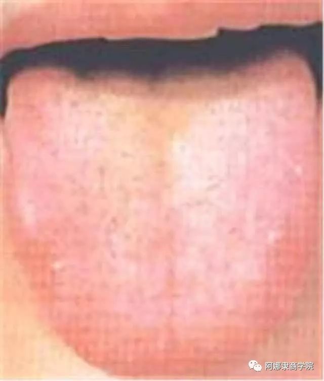 A Comprehensive Guide to 22 High-Definition Tongue Diagnosis Images: Understand Diseases Through Tongue Observation!