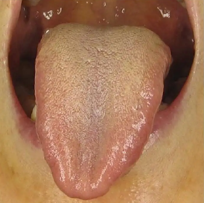 When Your Tongue Shows This Signal: Don't Delay!