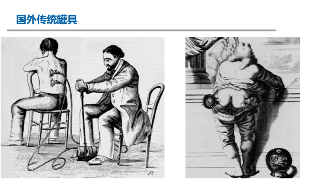 How to Use Cupping Therapy Without Pain?