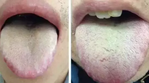 What Does Traditional Chinese Medicine Observe in the Tongue? Nine Body Types and Valuable Tongue Diagnosis Charts!