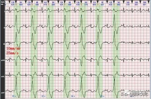 Understanding Pulse Patterns: Xu Mai, Wei Mai, Xi Mai, Dai Mai, and Duan Mai Explained for Everyone