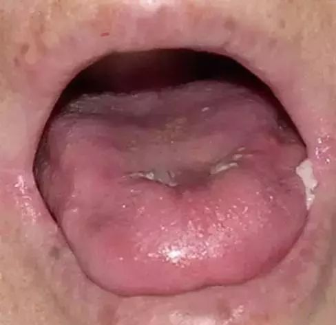 The Most Comprehensive Guide to Tongue Diagnosis! Master It and Become a Tongue Diagnosis Expert