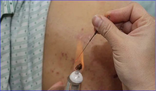 What Common Skin Diseases Can Fire Needle Therapy Treat?