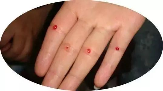 Utilizing the Four Seam Points for Bloodletting: Enhancing Appetite and Clearing Heat to Unblock Meridians