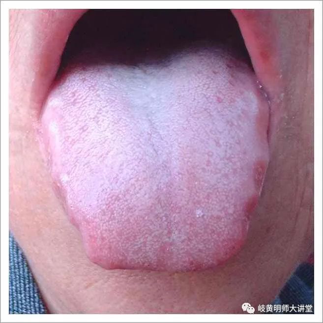 Traditional Chinese Medicine Tongue Diagnosis: Illustrated Guide to 14 Types of Tongue Shapes and Qualities