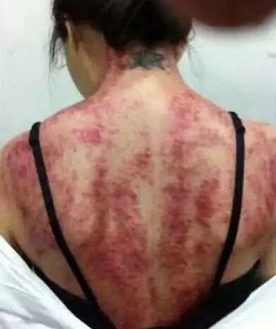 Caution After Gua Sha: Risks of Blood Vessel Rupture and Precautions for Certain Individuals