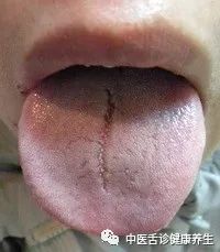 Nine Tongue Signs Indicating Qi Deficiency: Timely Adjustment and Medical Attention Recommended