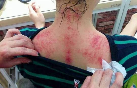 Benefits and Effects of Gua Sha on the Shoulders and Neck