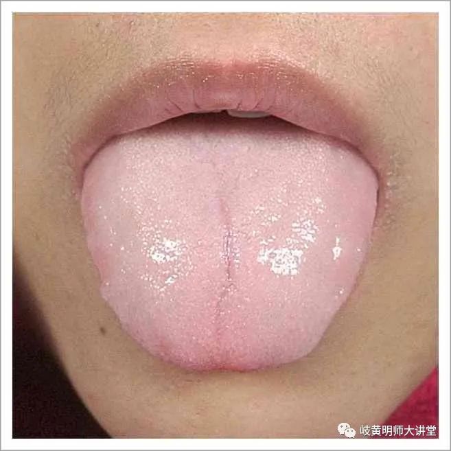 Traditional Chinese Medicine Tongue Diagnosis: Illustrated Guide to 14 Types of Tongue Shapes and Qualities