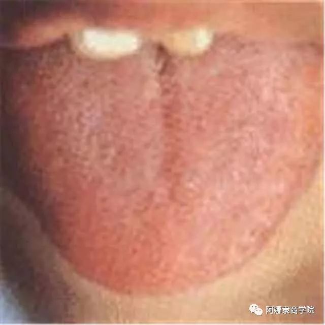 A Comprehensive Guide to 22 High-Definition Tongue Diagnosis Images: Understand Diseases Through Tongue Observation!