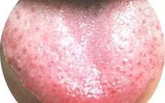 What Can Traditional Chinese Medicine Reveal Through Tongue Diagnosis?