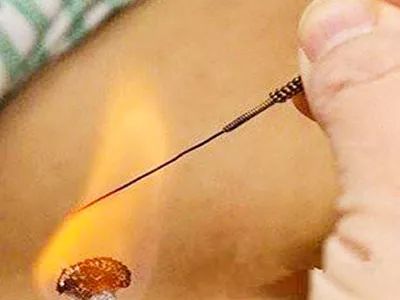 Fire Needle Therapy: A Unique Traditional Chinese Medicine Technique
