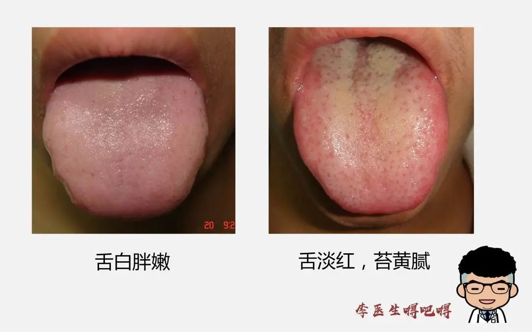 What Level of Tongue Diagnosis Does Western Medicine Have? Part 2: Tongue Quality and Coating
