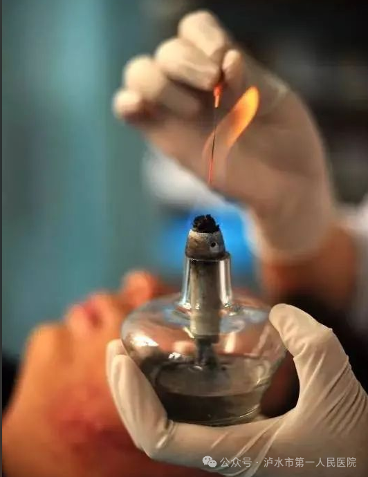 The Power of Small Needles: Lushui City First People's Hospital Implements Fire Needle and Bloodletting Cupping Therapy for Herpes Zoster