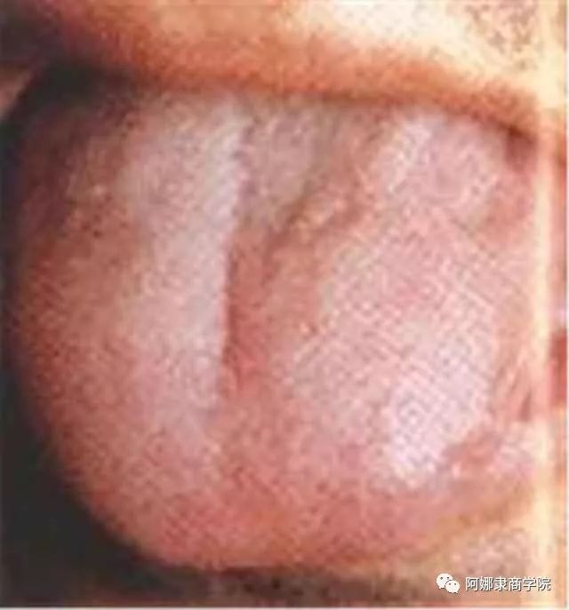 A Comprehensive Guide to 22 High-Definition Tongue Diagnosis Images: Understand Diseases Through Tongue Observation!