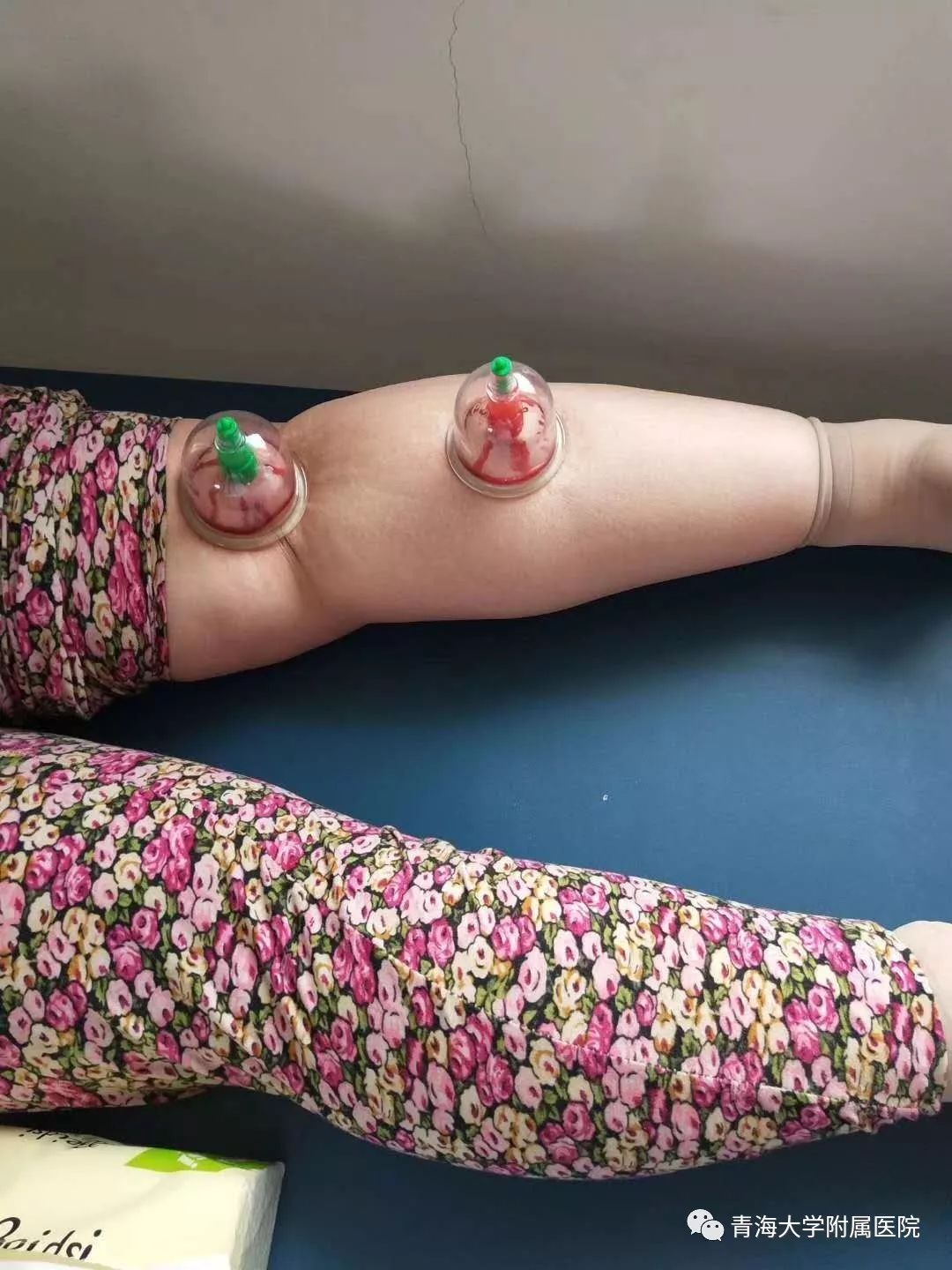 Understanding the Technique of Pricking and Cupping Therapy