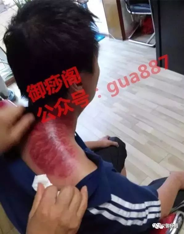 Why Gua Sha Should Not Be Limited to the Back: The Wonders of Gua Sha