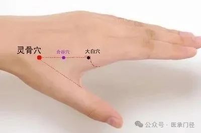 Traditional Fine Needle Technique for Acupuncture Treatment of Sciatica