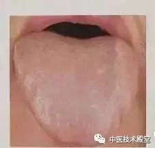 Tongue Diagnosis: Issues Revealed and Simple TCM Remedies