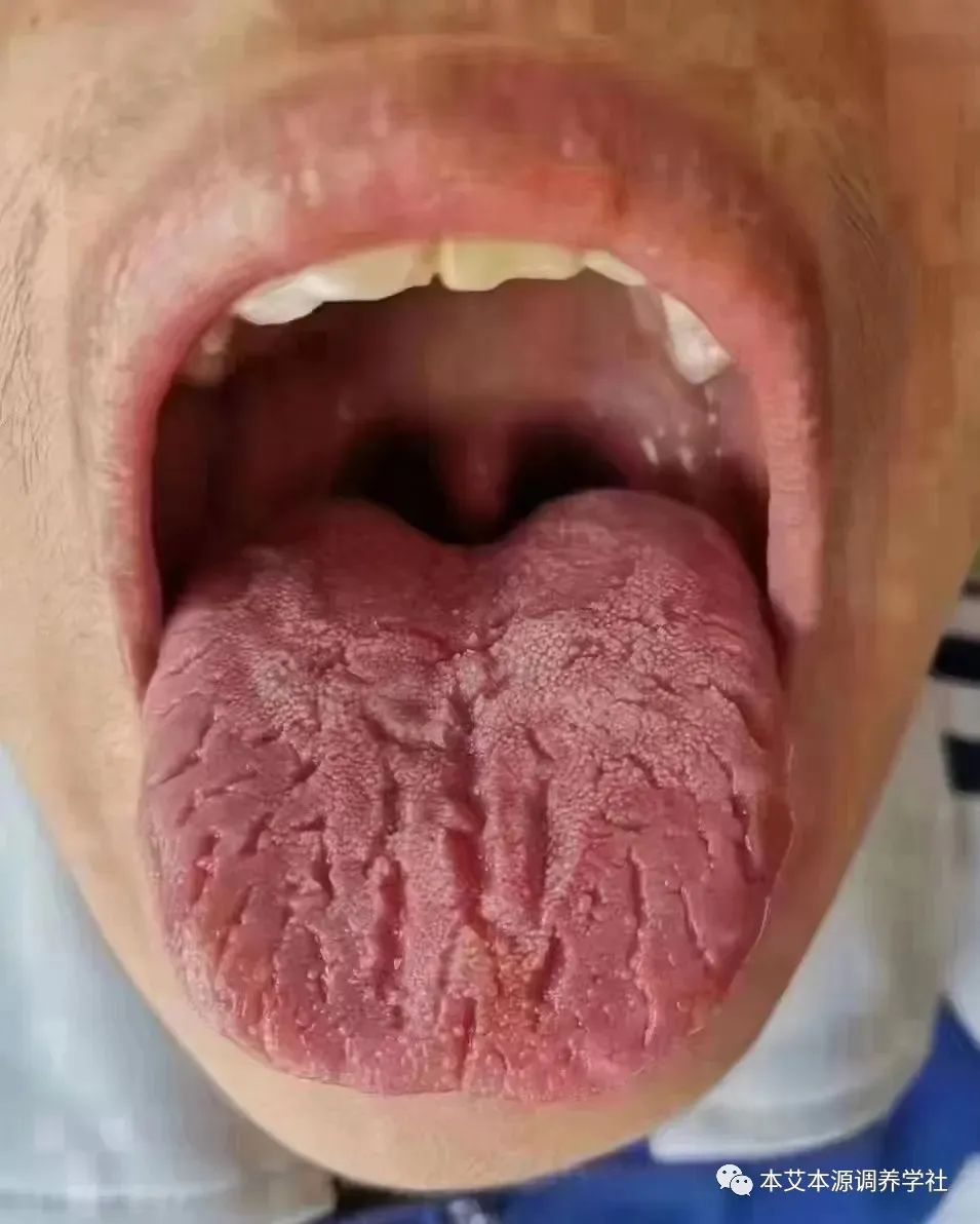 Tongue Diagnosis Series 3: Precise Differentiation of Tongue Coating, Quality, and Shape