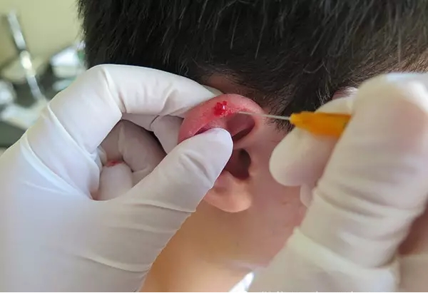 Prevention and Treatment of Exogenous Fever in Children According to Traditional Chinese Medicine