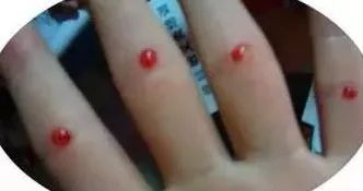 Utilizing the Four Seam Points for Bloodletting: Enhancing Appetite and Clearing Heat to Unblock Meridians