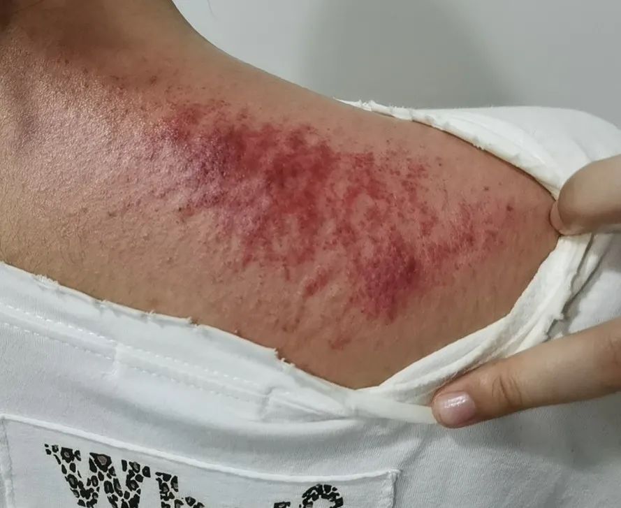 Understanding the Signs of Gua Sha: Master These 5 Colors and 4 Shapes for Better Health