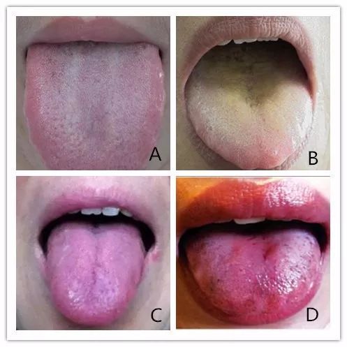Five Key Points of Tongue Diagnosis in Traditional Chinese Medicine