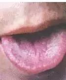 Comprehensive Guide to Tongue Diagnosis: Learn How Your Tongue Reflects Your Health!