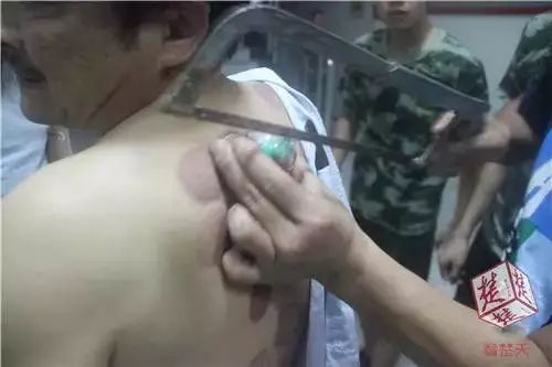 A Man Gets Stuck with a Cupping Jar at Home, Firefighters Help Cut It Off... Do You Really Understand Cupping?