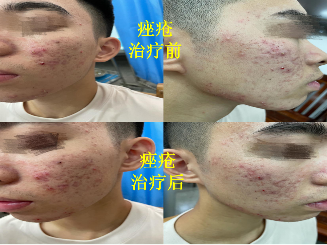 Essential Knowledge of Fire Needle Therapy in Dermatology