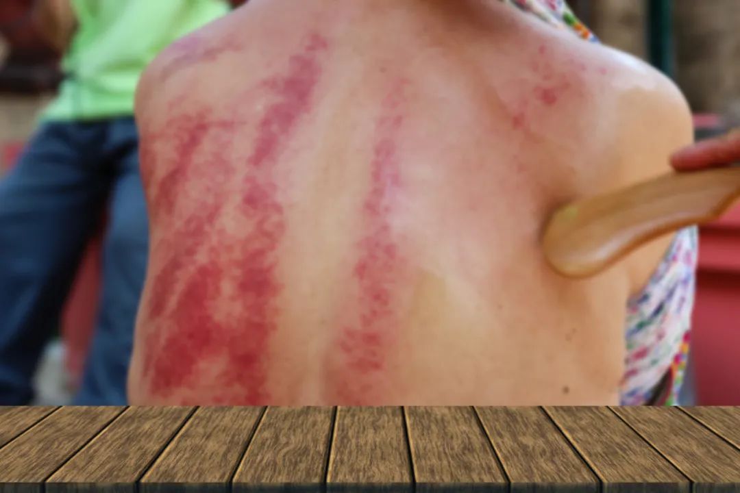 Does Excessive Gua Sha Deplete Your Energy? Self-Diagnosis Through Gua Sha for Early Health Awareness!