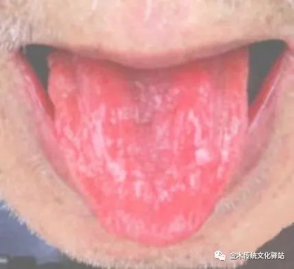 Tongue Diagnosis in Traditional Chinese Medicine: Characteristics of Tongue Coating