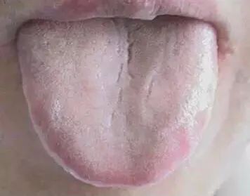 Tongue Diagnosis - Illustrated Guide to Tongue Manifestations