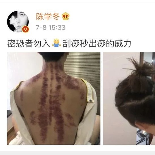 Caution: A Male Celebrity's Bare Back Photo Startles Netizens - Important Tips for Gua Sha This Summer