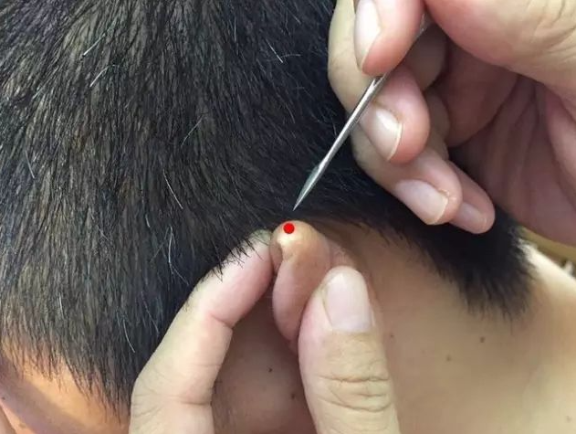 Bloodletting Therapy for 24 Difficult Diseases: A Unique TCM Approach