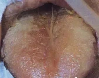 Understanding Tongue Diagnosis in Traditional Chinese Medicine (with Tongue Diagnosis Illustrations)
