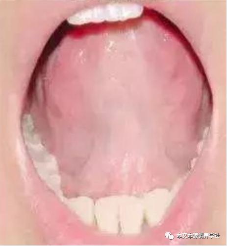 Tongue Diagnosis Series 3: Precise Differentiation of Tongue Coating, Quality, and Shape