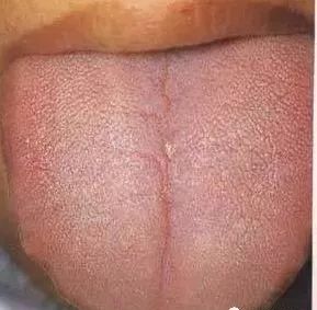 Understanding Tongue Diagnosis in Traditional Chinese Medicine (with Tongue Diagnosis Illustrations)
