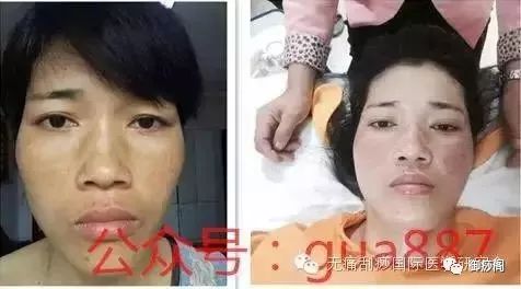 Why Gua Sha Should Not Be Limited to the Back: The Wonders of Gua Sha