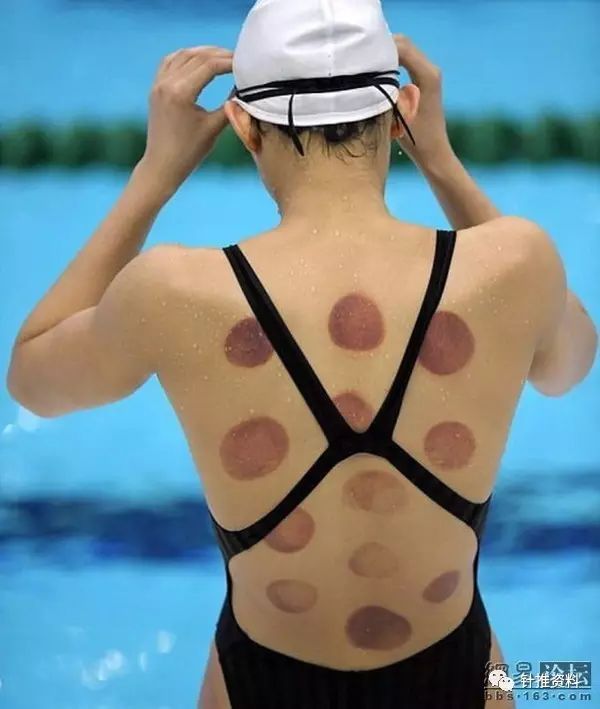 The Techniques and Diagnosis of Cupping Therapy in Traditional Chinese Medicine