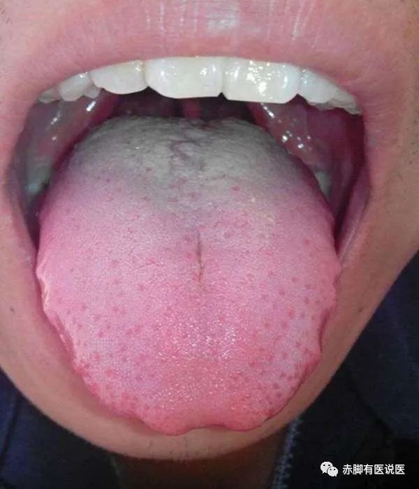 Understanding Your Tongue Diagnosis in 10 Minutes